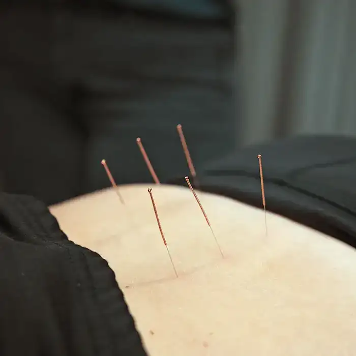 acupuncture on back of patient